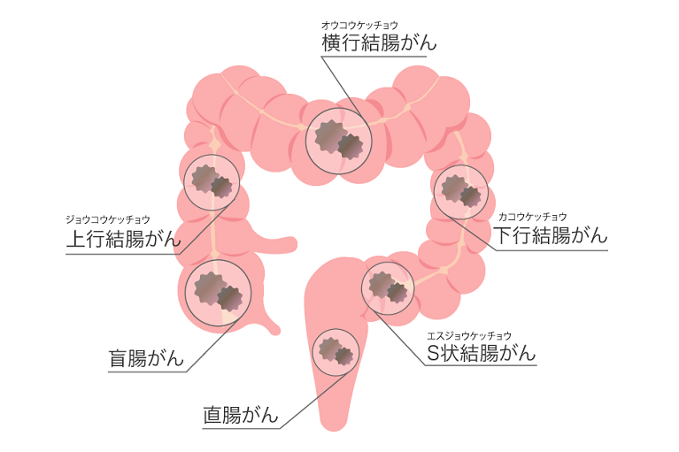大腸がんについて医師が詳しく解説