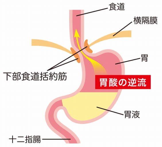 逆流性食道炎について医師が詳しく解説