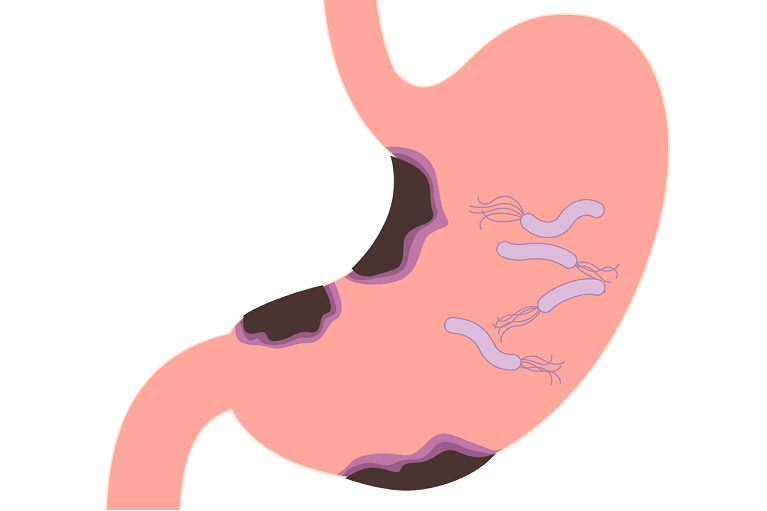 胃がんの原因はピロリ菌？